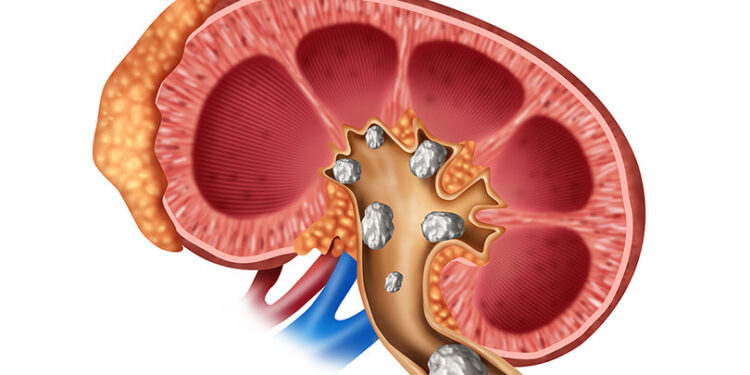 मिर्गौला सुन्निने समस्या किन हुन्छ ?